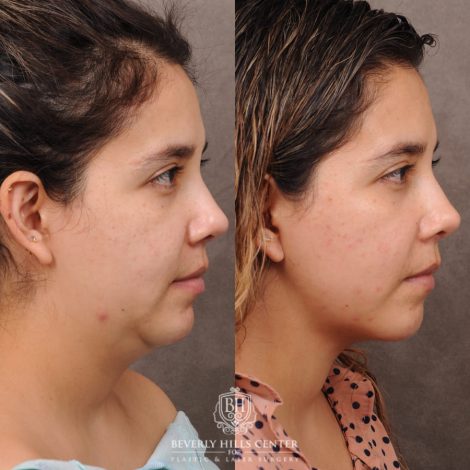 Beverly Hills Center Female Patient Before and After Weekend Lift
