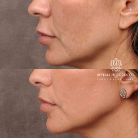 Beverly Hills Center Female Patient Before and After Upper Lip Lift