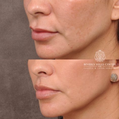 Beverly Hills Center Female Patient Before and After Upper Lip Lift