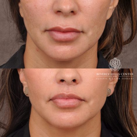 Beverly Hills Center Female Patient Before and After Upper Lip Lift