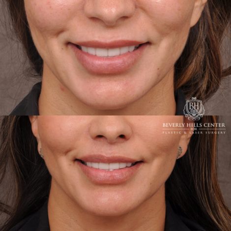 Beverly Hills Center Female Patient Before and After Upper Lip Lift