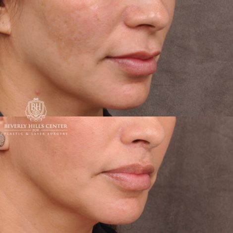 Beverly Hills Center Female Patient Before and After Upper Lip Lift