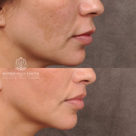Beverly Hills Center Female Patient Before and After Upper Lip Lift