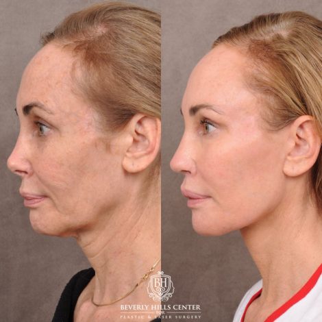 Beverly Hills Center Female Patient Before and After AuraLyft, Revision Rhino, Liplift, Silicone removal to lips and Upper Blepharoplasty