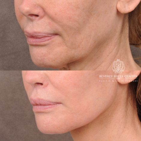 Beverly Hills Center Female Patient Before and After AuraLyft, Revision Rhino, Liplift, Silicone removal to lips and Upper Blepharoplasty