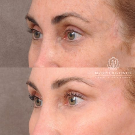 Beverly Hills Center Female Patient Before and After AuraLyft, Revision Rhino, Liplift, Silicone removal to lips and Upper Blepharoplasty