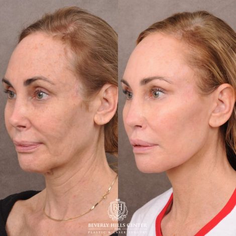 Beverly Hills Center Female Patient Before and After AuraLyft, Revision Rhino, Liplift, Silicone removal to lips and Upper Blepharoplasty
