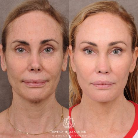 Beverly Hills Center Female Patient Before and After AuraLyft, Revision Rhino, Liplift, Silicone removal to lips and Upper Blepharoplasty