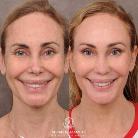 Beverly Hills Center Female Patient Before and After AuraLyft, Revision Rhino, Liplift, Silicone removal to lips and Upper Blepharoplasty