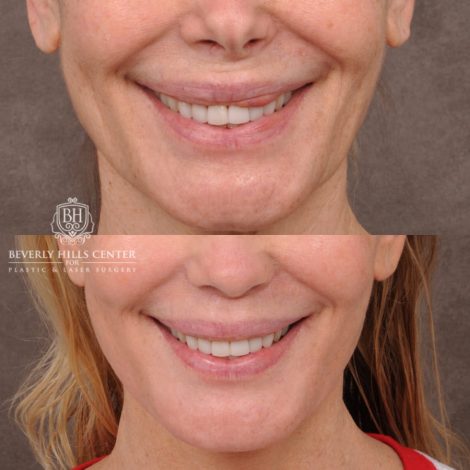Beverly Hills Center Female Patient Before and After AuraLyft, Revision Rhino, Liplift, Silicone removal to lips and Upper Blepharoplasty