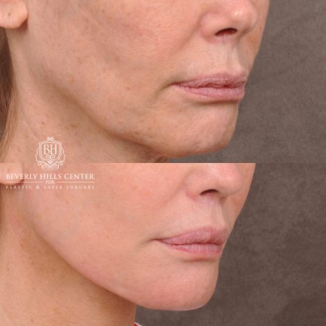 Beverly Hills Center Female Patient Before and After AuraLyft, Revision Rhino, Liplift, Silicone removal to lips and Upper Blepharoplasty