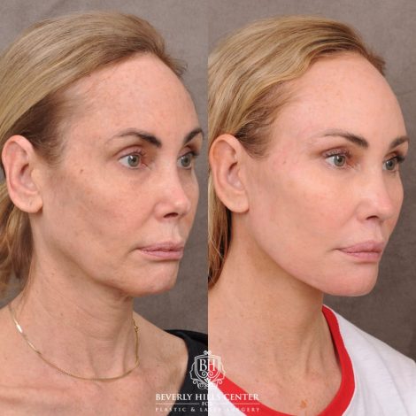Beverly Hills Center Female Patient Before and After AuraLyft, Revision Rhino, Liplift, Silicone removal to lips and Upper Blepharoplasty