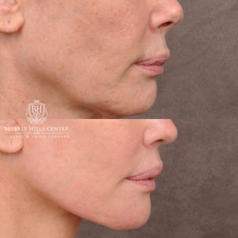 Beverly Hills Center Female Patient Before and After AuraLyft, Revision Rhino, Liplift, Silicone removal to lips and Upper Blepharoplasty