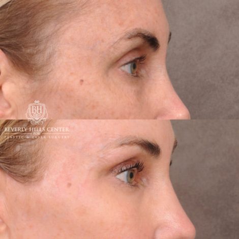 Beverly Hills Center Female Patient Before and After AuraLyft, Revision Rhino, Liplift, Silicone removal to lips and Upper Blepharoplasty