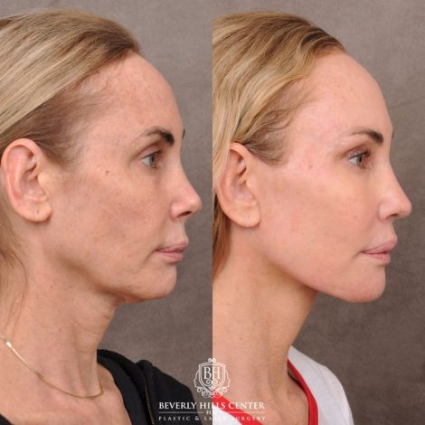 Beverly Hills Center Female Patient Before and After AuraLyft, Revision Rhino, Liplift, Silicone removal to lips and Upper Blepharoplasty