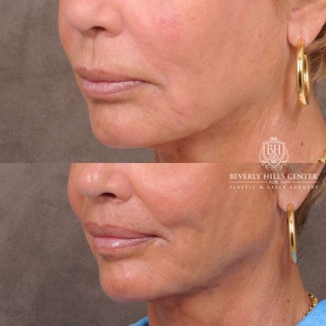 Beverly Hills Center Female Patient Before and After Lip Lift