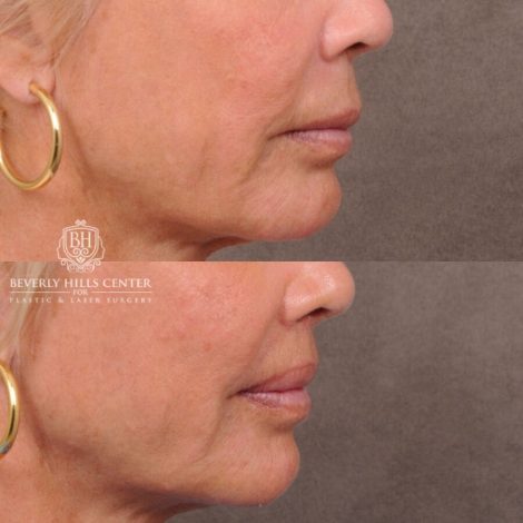 Beverly Hills Center Female Patient Before and After Lip Lift