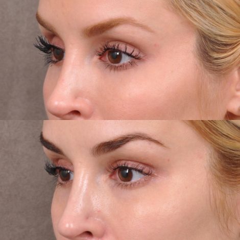 Beverly Hills Center Patient Before and After Upper Lip Lift with Deep Release with Infra Brow Filler