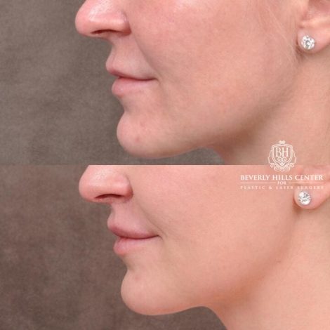 Beverly Hills Center Female Patient Before and After Deep Plane Upper Lip Lift With Corner Reveal Lifts Procedure