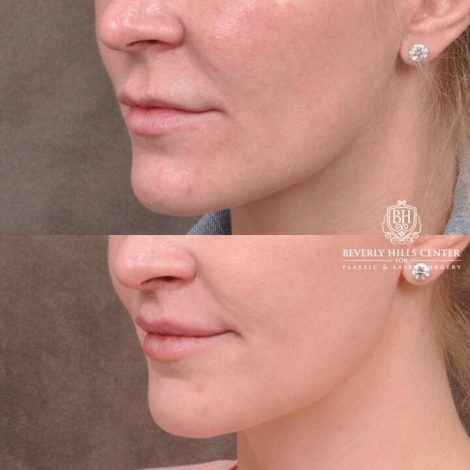 Beverly Hills Center Female Patient Before and After Deep Plane Upper Lip Lift With Corner Reveal Lifts Procedure