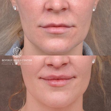 Beverly Hills Center Female Patient Before and After Deep Plane Upper Lip Lift With Corner Reveal Lifts Procedure