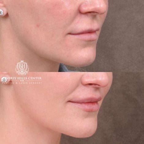 Beverly Hills Center Female Patient Before and After Deep Plane Upper Lip Lift With Corner Reveal Lifts Procedure