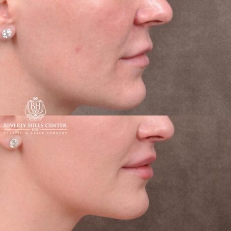 Beverly Hills Center Female Patient Before and After Deep Plane Upper Lip Lift With Corner Reveal Lifts Procedure