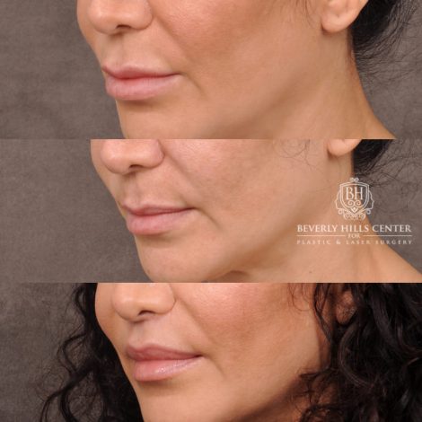 Beverly Hills Center Female Patient Before and After Deep Plane Upper Lip Lift