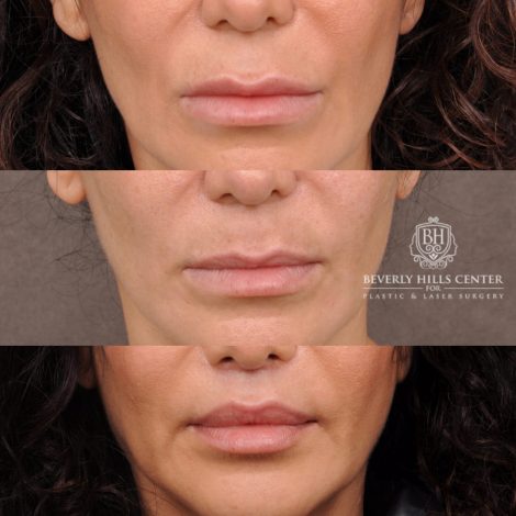 Beverly Hills Center Female Patient Before and After Deep Plane Upper Lip Lift