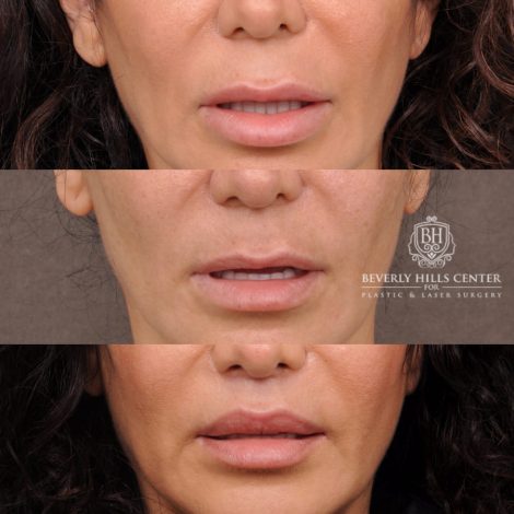 Beverly Hills Center Female Patient Before and After Deep Plane Upper Lip Lift