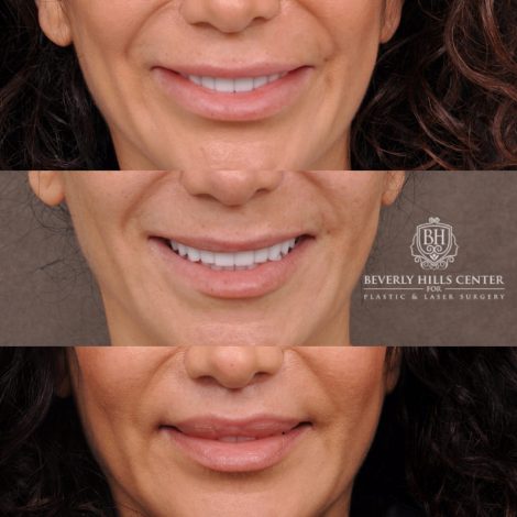 Beverly Hills Center Female Patient Before and After Deep Plane Upper Lip Lift