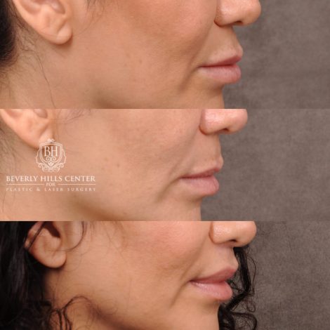 Beverly Hills Center Female Patient Before and After Deep Plane Upper Lip Lift