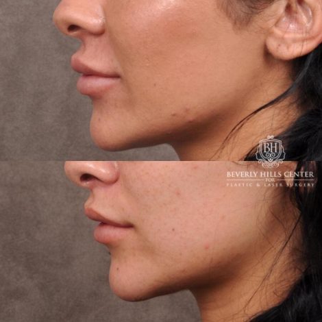 Beverly Hills Center Female Patient Before and After Deep Plane Lip Lift