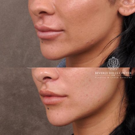 Beverly Hills Center Female Patient Before and After Deep Plane Lip Lift