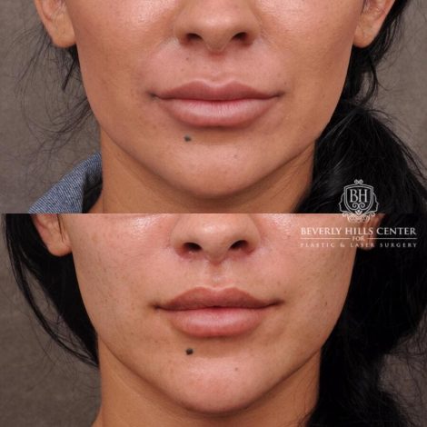 Beverly Hills Center Female Patient Before and After Deep Plane Lip Lift