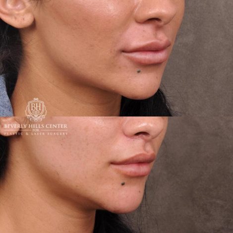 Beverly Hills Center Female Patient Before and After Deep Plane Lip Lift