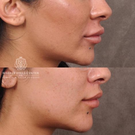 Beverly Hills Center Female Patient Before and After Deep Plane Lip Lift