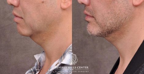 Beverly Hills Center Male Patient Before and After Weekend Necklift Neck Lipo Profound RF Chin Implant Platysmaplasty PRP Hair