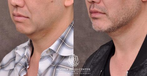Beverly Hills Center Male Patient Before and After Weekend Necklift Neck Lipo Profound RF Chin Implant Platysmaplasty PRP Hair
