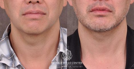 Beverly Hills Center Male Patient Before and After Weekend Necklift Neck Lipo Profound RF Chin Implant Platysmaplasty PRP Hair