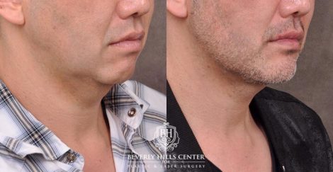 Beverly Hills Center Male Patient Before and After Weekend Necklift Neck Lipo Profound RF Chin Implant Platysmaplasty PRP Hair