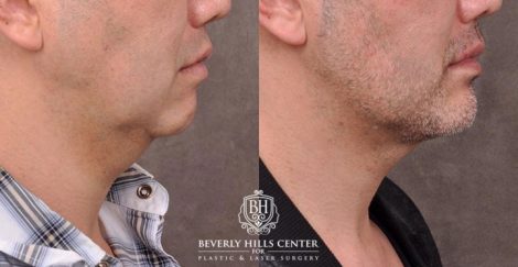 Beverly Hills Center Male Patient Before and After Weekend Necklift Neck Lipo Profound RF Chin Implant Platysmaplasty PRP Hair