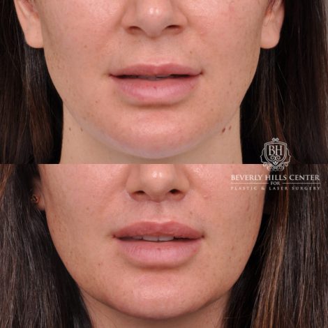 Beverly Hills Center Female Patient Before and After Deep Plane Upper Lip Lift