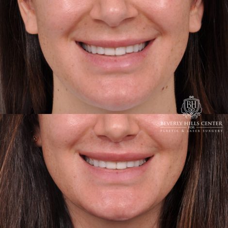 Beverly Hills Center Female Patient Before and After Deep Plane Upper Lip Lift