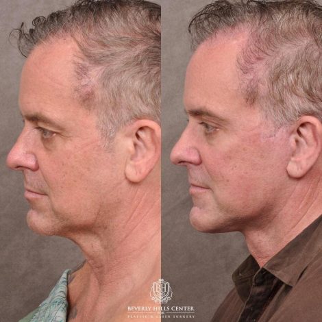 Beverly Hills Center Male Patient Before and After Comprehensive Auralyft with Brow Lift, Upper and Lower Eyelid Bleph and Ptosis Repair