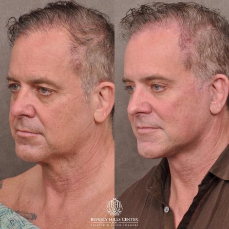 Beverly Hills Center Male Patient Before and After Comprehensive Auralyft with Brow Lift, Upper and Lower Eyelid Bleph and Ptosis Repair