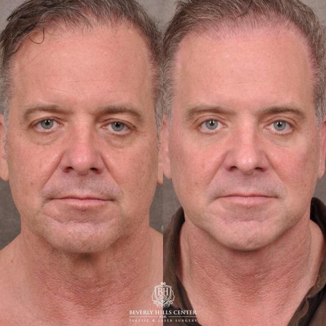 Beverly Hills Center Male Patient Before and After Comprehensive Auralyft with Brow Lift, Upper and Lower Eyelid Bleph and Ptosis Repair