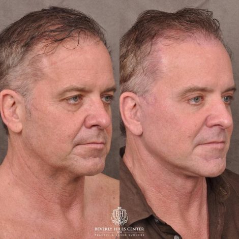 Beverly Hills Center Male Patient Before and After Comprehensive Auralyft with Brow Lift, Upper and Lower Eyelid Bleph and Ptosis Repair