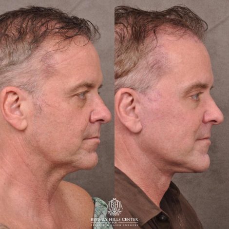 Beverly Hills Center Male Patient Before and After Comprehensive Auralyft with Brow Lift, Upper and Lower Eyelid Bleph and Ptosis Repair