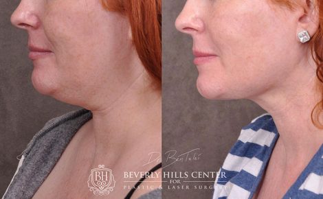 Beverly Hills Center Female Patient Before and After Mini Weekend Necklift Procedure